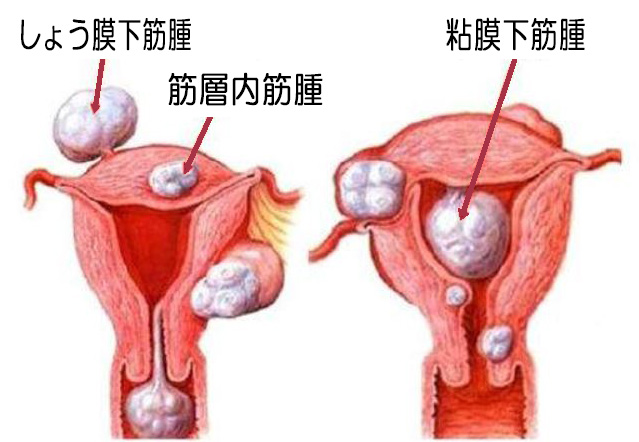 筋腫イラスト1