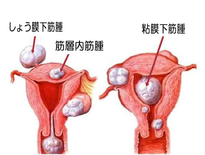 筋腫図